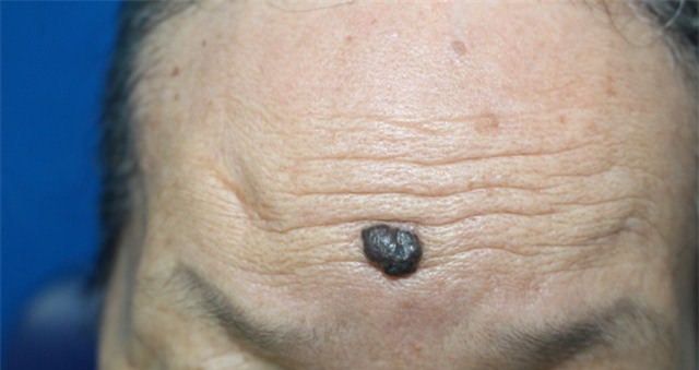 Cảnh báo gia tăng bệnh nhân ung thư da, nhiều người không biết mình mắc bệnh-4