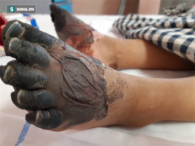 Sự thật về thông tin bé gái ở Lai Châu bị hoại tử chân tay do mắc bệnh Than hiếm gặp - Ảnh 2.