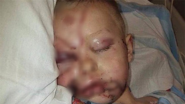 Bức ảnh mà các bậc phụ huynh nên lưu tâm chụp bé trai bị biến dạng khuôn mặt vì 2 con chó tấn công - Ảnh 1.