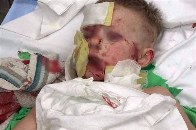 Bức ảnh mà các bậc phụ huynh nên lưu tâm chụp bé trai bị biến dạng khuôn mặt vì 2 con chó tấn công - Ảnh 2.