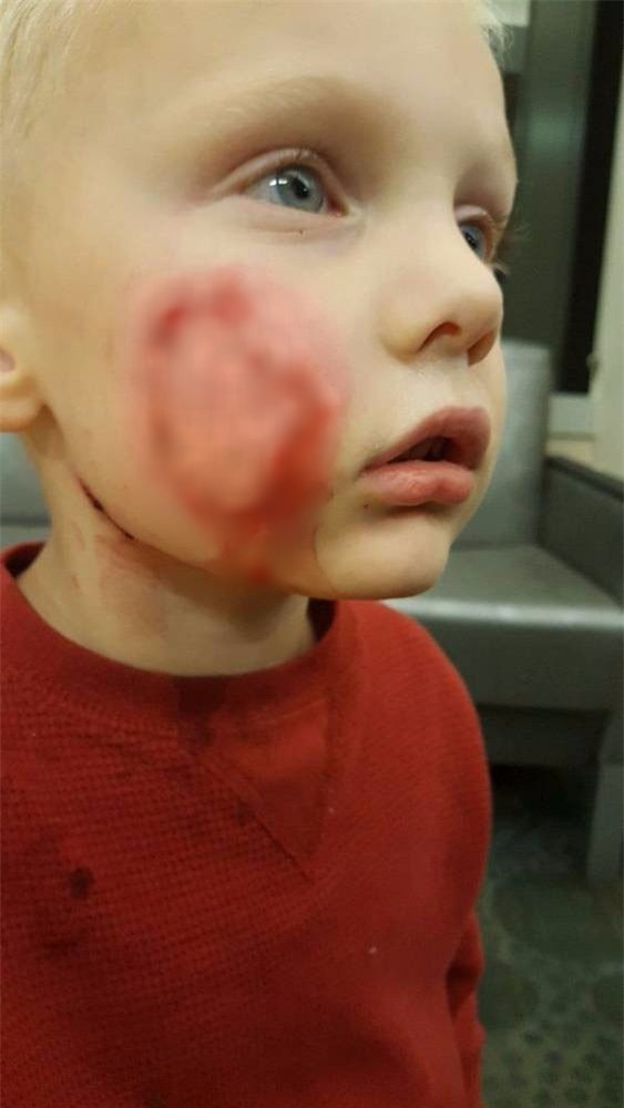 Bức ảnh mà các bậc phụ huynh nên lưu tâm chụp bé trai bị biến dạng khuôn mặt vì 2 con chó tấn công - Ảnh 4.