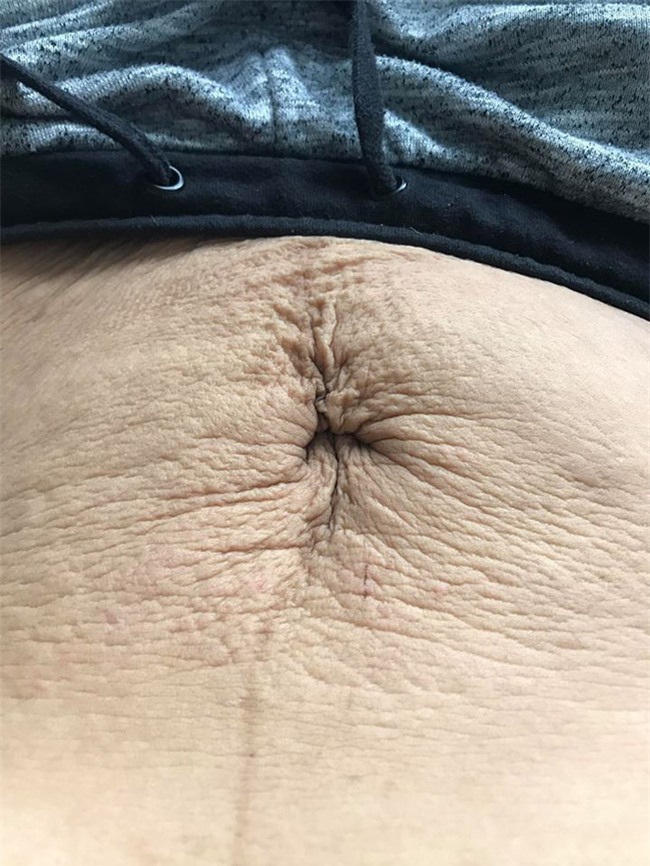 Vết rạn - tâm sự của người phụ nữ vừa sinh đôi gây xúc động mạnh - Ảnh 4.