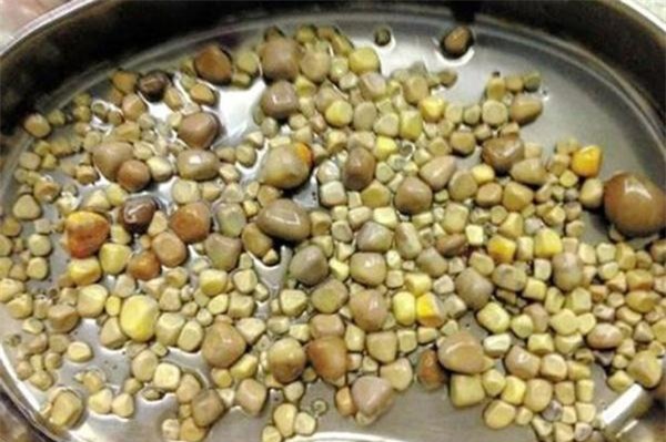 Những trường hợp "gặp họa" vì ăn uống khiến các bác sĩ không thể thốt lên lời - 2