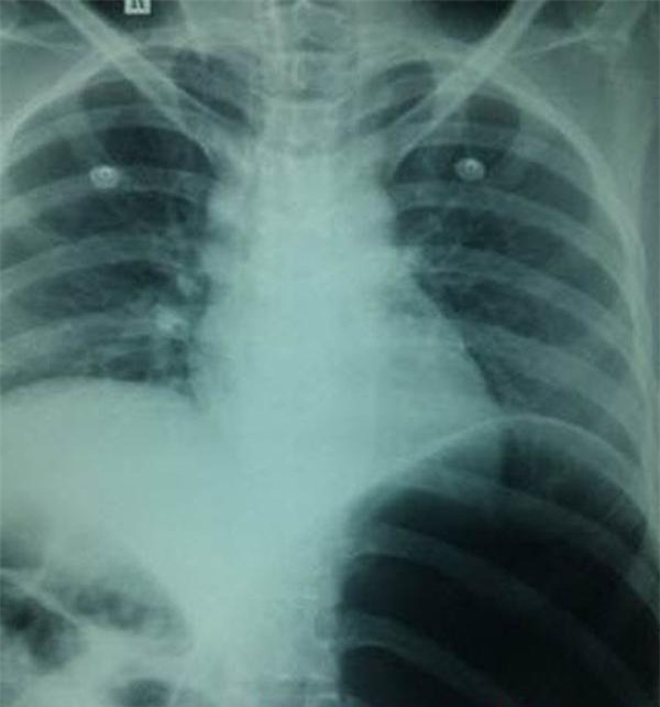 Những trường hợp "gặp họa" vì ăn uống khiến các bác sĩ không thể thốt lên lời - 3