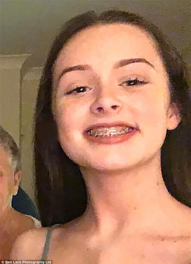 Cô gái 15 tuổi suýt chết vì bệnh nhiễm khuẩn, nguyên nhân được chẩn đoán là từ... niềng răng - Ảnh 1.