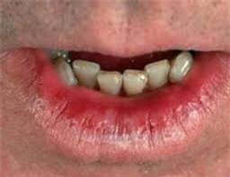 Viêm môi ánh sáng, nguy cơ ung thư-3