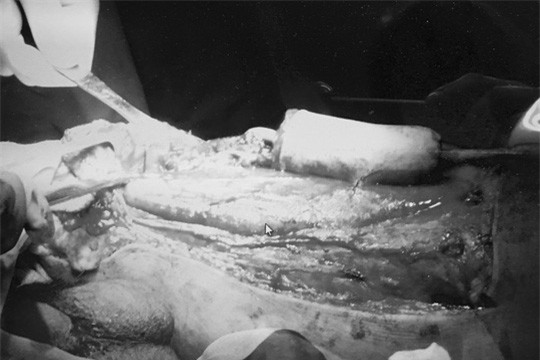 Thanh niên bị cắt của quý vì đắp thuốc nam cho... cậu nhỏ-2