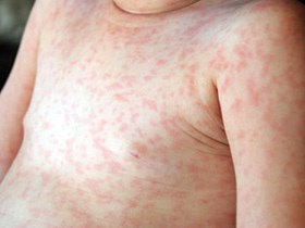 Hữu ích: Bác sĩ giúp mẹ phân biệt bệnh sởi và sốt phát ban