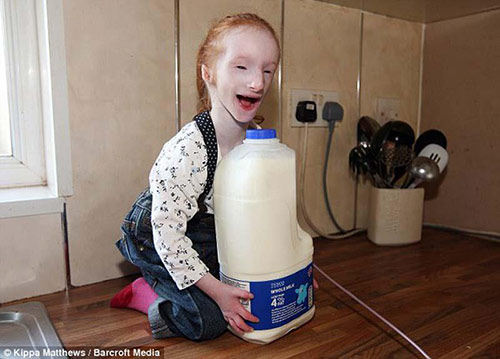 Từ khi mới sinh ra, Charlotte Garside đã mang trong mình một dạng của căn bệnh Primordial Dwarfism (còi cọc bẩm sinh).