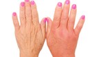 7 dấu hiệu cảnh báo bệnh nguy hiểm biểu hiện trên bàn tay của bạn-7