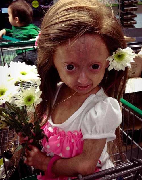 Adalia Rose Williams, sinh ngày 10/12/2006, đến từ Round Rock, Texas được chuẩn đoán mắc phải hội chứng hiếm gặp mang tên Progeria từ khi mới sinh.