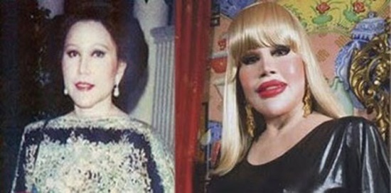 Với tham vọng trở thành một búp bê Barbie sống, nữ diễn viên Thái Lan là Sumanee Gunakasem đã tự biến mình thành thảm họa khi nhờ cậy đến dao kéo.