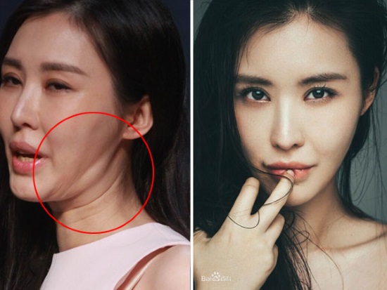 Nữ diễn viên Meme Tian với những khuôn mặt cô đều bị cứng đờ, không được tự nhiên và xuất hiện những nếp nhăn phía dưới hàm.