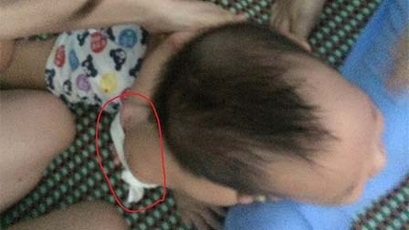 Cháu bé bị 3 giáo viên mầm non bạo hành phải nhập viện