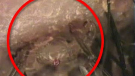 Gần 100 con rận mu làm tổ trên mi mắt người đàn ông-3