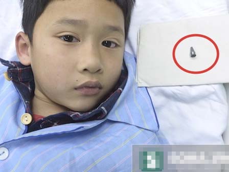 Quên xương vịt trong phế quản, 3 tháng sau mới biết-3