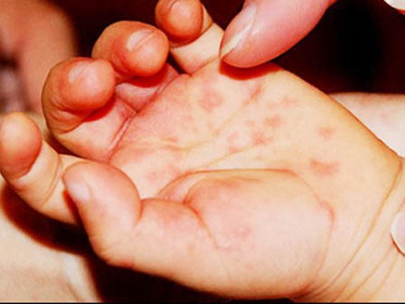 Hà Nội bệnh tay chân miệng đang bắt đầu gia tăng