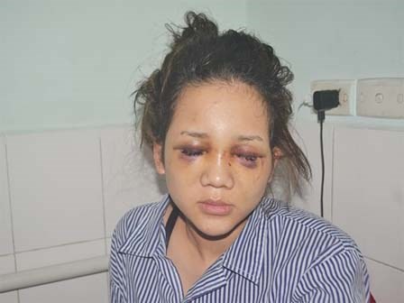 Phút kinh hãi cô gái bị thiếu uý CA đánh chấn thương não