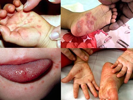 Hà Nội gia tăng số trẻ mắc tay chân miệng