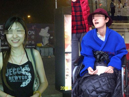 Nữ thạc sĩ xinh đẹp và thành đạt bị động kinh sau khi phẫu thuật thẩm mỹ gọt hàm