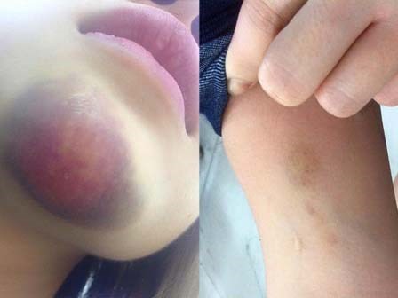 Nữ sinh tố bị phụ xe sàm sỡ và đánh bầm dập trên xe buýt