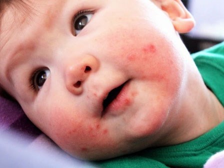 Bệnh tay chân miệng vào mùa, cha mẹ đừng nhầm lẫn để bệnh con thêm nặng