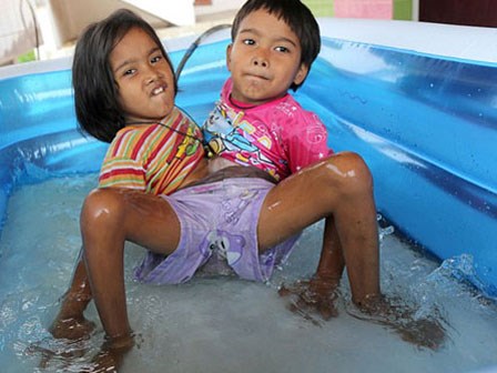 Cuộc sống vui vẻ của cặp sinh đôi dính liền thân dưới