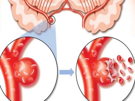 Cẩn thận đột quỵ nếu xuất hiện dấu hiệu này 2 ngày không khỏi