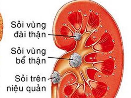 Bé 3 tuổi bị sỏi thận 2cm khiến phụ huynh