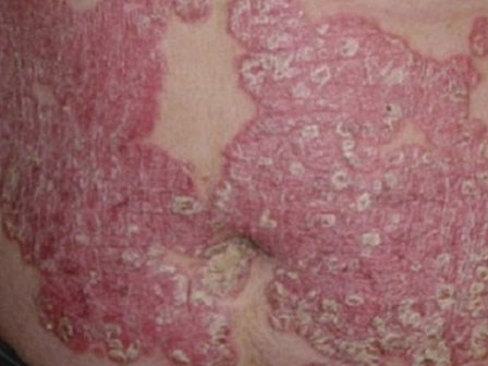Tác dụng phụ kinh hoàng của thần dược corticoid