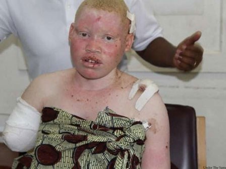 Rùng rợn cô gái bạch tạng bị lấy mắt, cắt ngực 