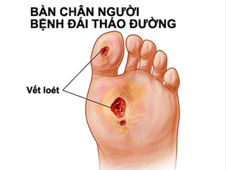 Nguy cơ mắc tiểu đường vì ăn nhiều thực phẩm nhiễm thuốc trừ sâu
