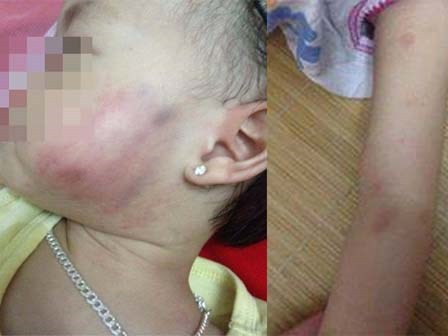 Bé gái bị bầm tím mặt: Cô giáo xin lỗi tiết lộ sự thật