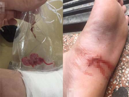 Thanh niên suýt bị cưa chân vì... cục bông gòn bác sĩ