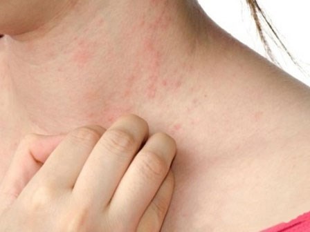 Cách xử lý các bệnh dị ứng thường gặp vào mùa hè
