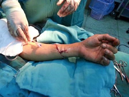 Con rể chém gần đứt lìa tay cha vợ