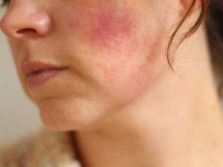 5 tác nhân thường gặp khiến da ngày càng mỏng yếu