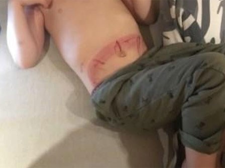 Bé rách bụng vì bị hút vào ống thoát nước của bồn tắm
