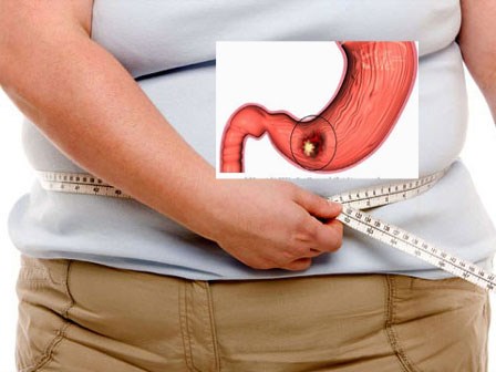 5 đối tượng cần phải cảnh giác vì dễ mắc ung thư dạ dày