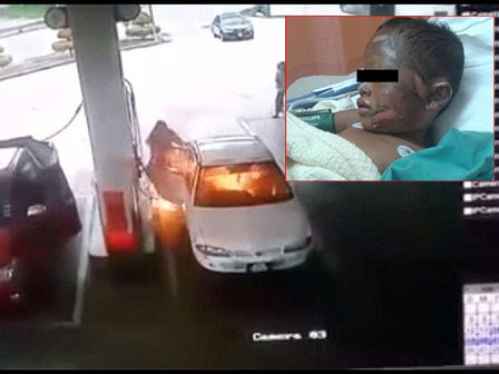 Kinh hoàng bé trai thành đuốc sống khi chơi bật lửa lúc mẹ đổ xăng