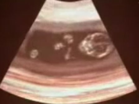 Người mẹ quyết định phá thai nhưng diễn biến sau đó khiến cô chết lặng