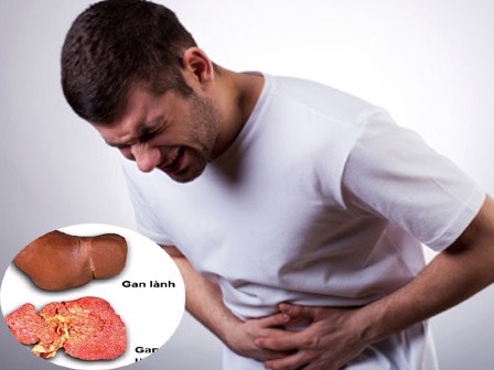 Giảm 1-2 kg/tháng, hãy nghĩ đến ung thư gan