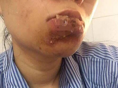 Xót xa cô gái Quảng Ninh phải cắt bỏ môi sau khi tiêm chất làm đầy