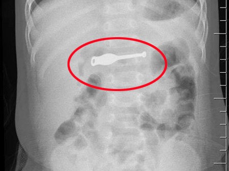 Bé trai 10 tháng nuốt que lấy ráy tai 10cm vào bụng