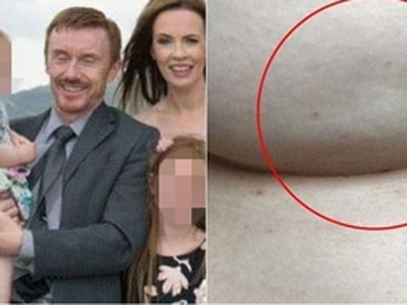 Bà mẹ 2 con chia sẻ dấu hiệu nhận biết ung thư từ 