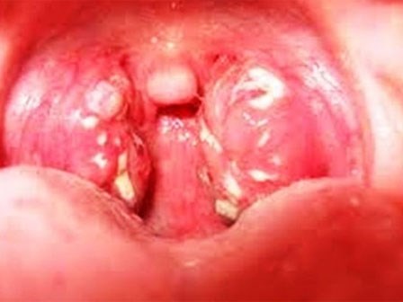 Dấu hiệu nhận biết, cách phòng tránh bệnh bạch hầu