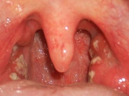 Bệnh bạch hầu gây chết người nhưng đang bị nhầm là viêm họng