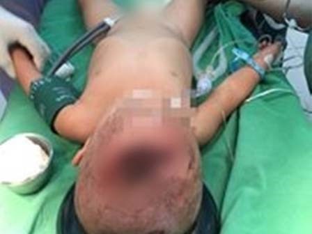 Nóng giận, cha dùng cốc uống nước ném con 18 tháng tuổi chấn thương sọ não