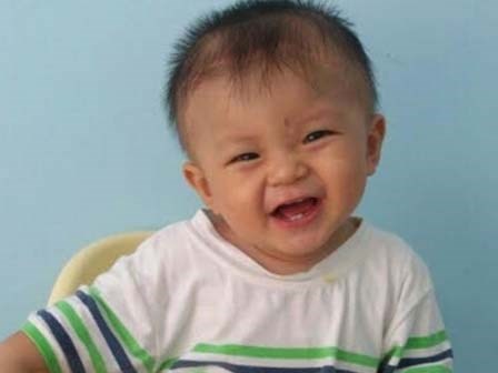 Cậu bé bị đâm xuyên não khỏe mạnh đón lễ thôi nôi