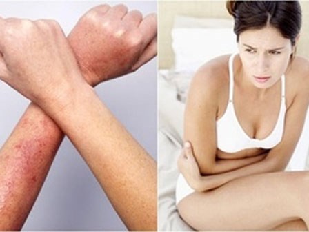 Loạt bệnh ngoài da thường gặp vào mùa hè và cách xử lý
